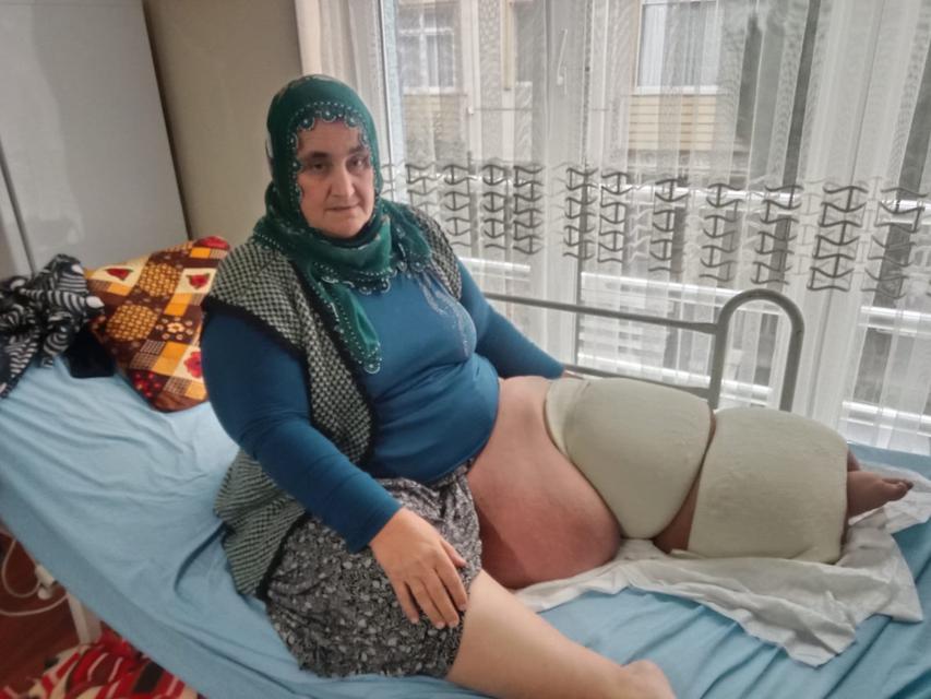 Fil hastalığı bacağını 100 kilo yaptı