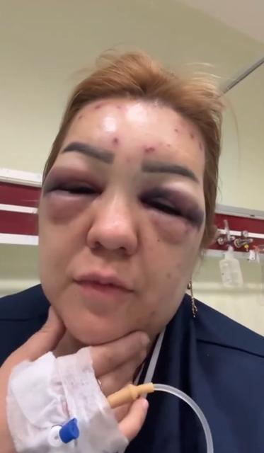 BOTOKS BU HALE GETİRDİ: YÜZÜ ŞİŞTİ TANINMAYACAK HALE GELDİ BOTOKS MAĞDURU KADIN: "SİZ DE BİLMEDİĞİNİZ HİÇBİR YERE GİTMEYİN, DOKTOR HARİCİ KİMSEYE YAPTIRMAYIN ARKADAŞLAR"