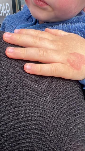 Kreşe bıraktığı çocuğunu darp edilmiş halde aldı