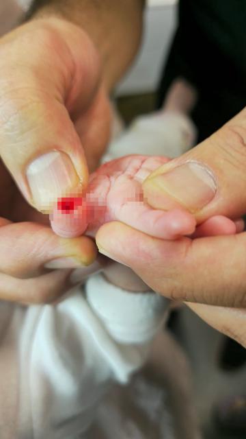 SERUM ÇIKARMA İŞLEMİ ESNASINDA SARGIYLA BİRLİKTE BEBEĞİN PARMAĞI KESİLDİ