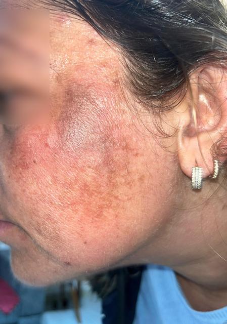 GÜZELLEŞMEK UĞRUNA GİTTİĞİ MERKEZDE YÜZÜ YANDI YÜZÜNDE 2. DERECE YANIK OLAN KADIN: "2 YAŞINDAKİ OĞLUM BENİ BÖYLE GÖRÜNCE 'ÖCÜ' DİYEREK KAÇIP DÜŞTÜ" "GÜZELLİK MERKEZİNDEN VE İŞLEMİ YAPAN KADINDAN ŞİKAYETÇİ OLDUM" "GÜZELLİK MERKEZİ DALGA GEÇEREK TELEFONU KAPATTI"