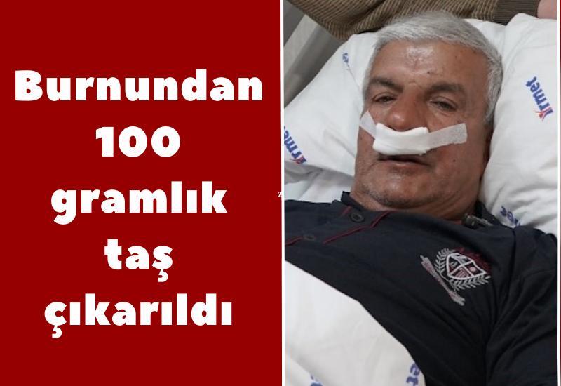 Burnundan 100 gramlık taş çıkarıldı