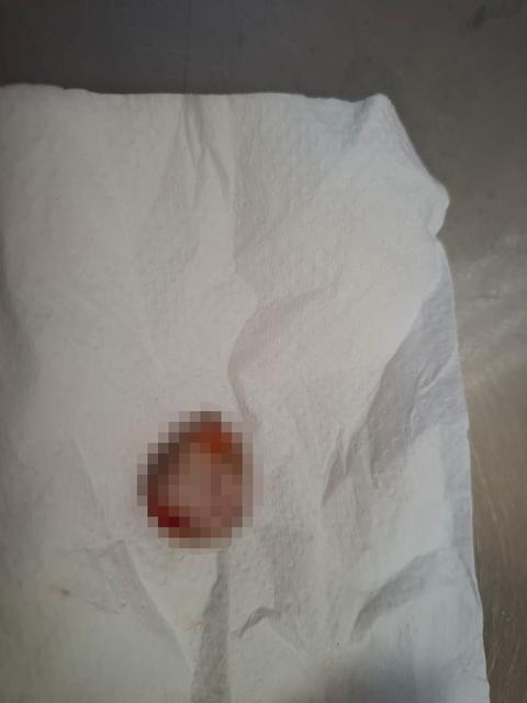 Kopan parmağını poşete koyup doktora getirdi