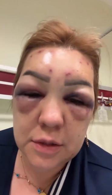 BOTOKS BU HALE GETİRDİ: YÜZÜ ŞİŞTİ TANINMAYACAK HALE GELDİ BOTOKS MAĞDURU KADIN: "SİZ DE BİLMEDİĞİNİZ HİÇBİR YERE GİTMEYİN, DOKTOR HARİCİ KİMSEYE YAPTIRMAYIN ARKADAŞLAR"