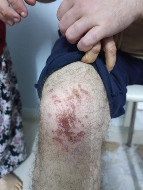 YÜZDE 90 ENGELLİ VATANDAŞ ACIMASIZCA DARP EDİLDİ "DİZLERİ, OMUZLARI VE YÜZÜ YARA İÇİNDE" "KONUŞAMAZ, DUYAR VE KENDİ İHTİYAÇLARINI KENDİ YAPAMAZ"