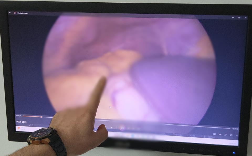 TÜM ORGANLARI TERS YERDE: DOKTORLAR BİLE ŞAŞIRDI KALBİNİN SAĞDA OLDUĞUNU 26 YAŞINDA, TÜM ORGANLARININ TERS OLDUĞUNU 54 YAŞINDA ÖĞRENDİ
