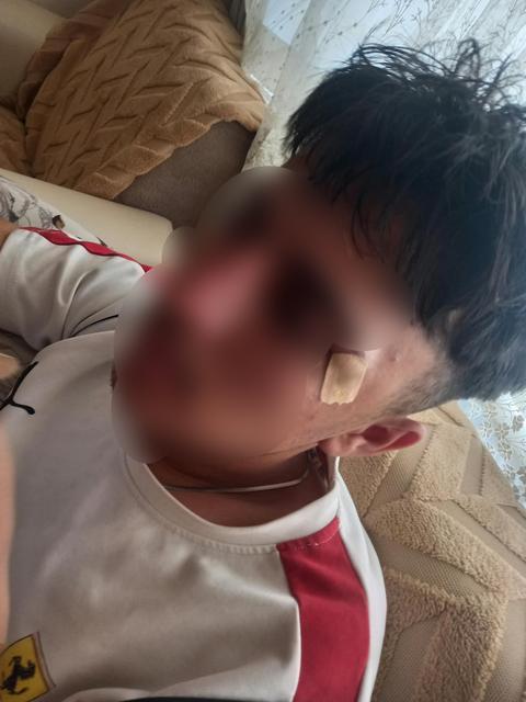 ÖĞRETMENİN KAFA ATTIĞI ÇOCUĞUN BURNU KIRILDI AİLE ŞİKAYETÇİ OLDU, SAVCILIK SORUŞTURMA BAŞLATTI