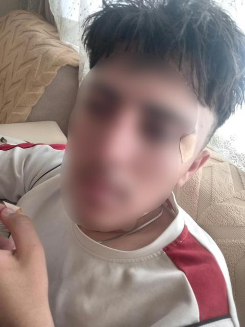 ÖĞRETMENİN KAFA ATTIĞI ÇOCUĞUN BURNU KIRILDI AİLE ŞİKAYETÇİ OLDU, SAVCILIK SORUŞTURMA BAŞLATTI